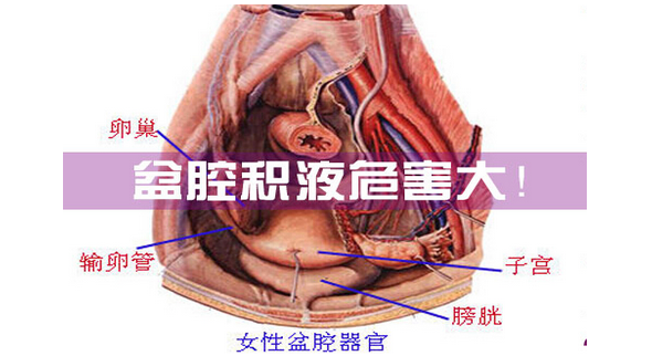 慢性盆腔積液