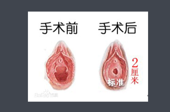 處女膜修補