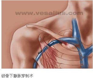 動靜脈穿刺術