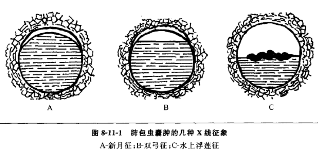 肺棘球蚴囊腫摘除術