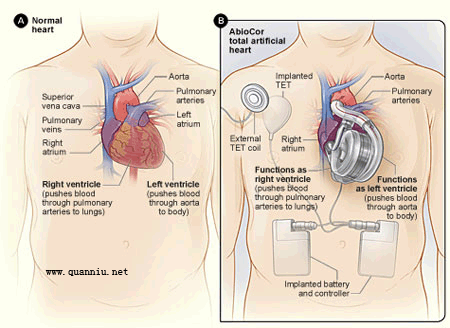 AbioCor