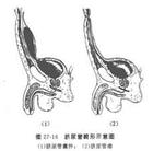 臍尿管囊腫及臍尿管瘺