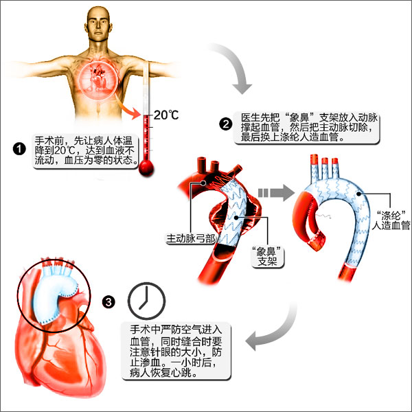 全弓置換手術