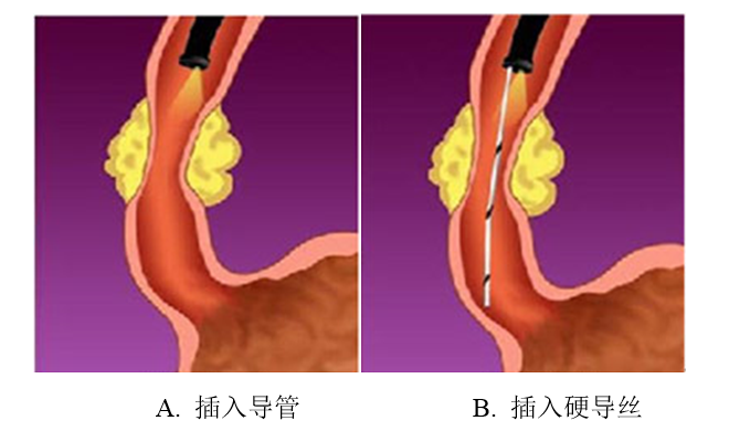 食道支架