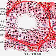 喉咽腫瘤