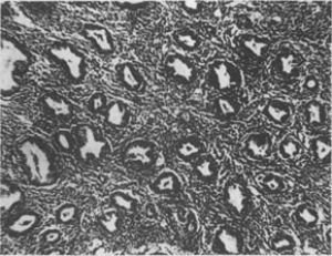 內分泌不孕(內分泌性不孕)