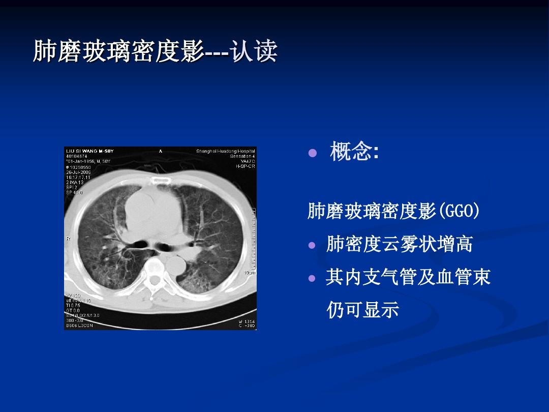 肺內磨玻璃密度影