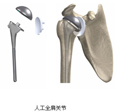 人工肩關節