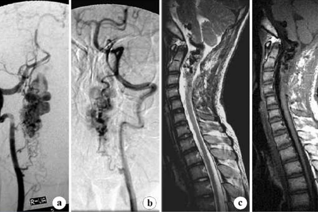 第Ⅱ,Ⅲ型脊髓血管畸形