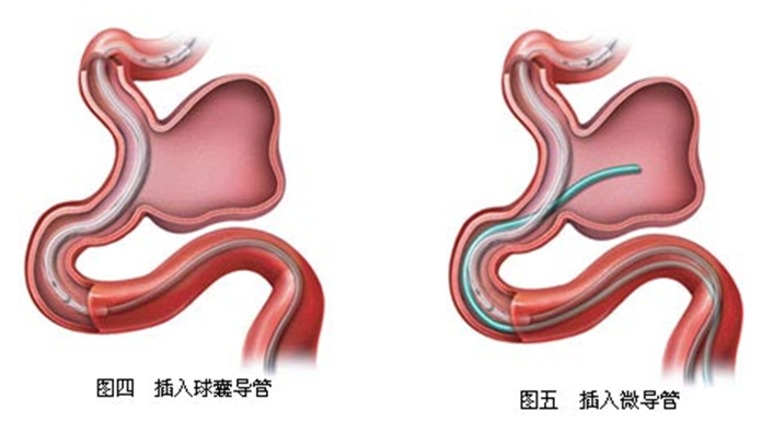 腦血管栓塞