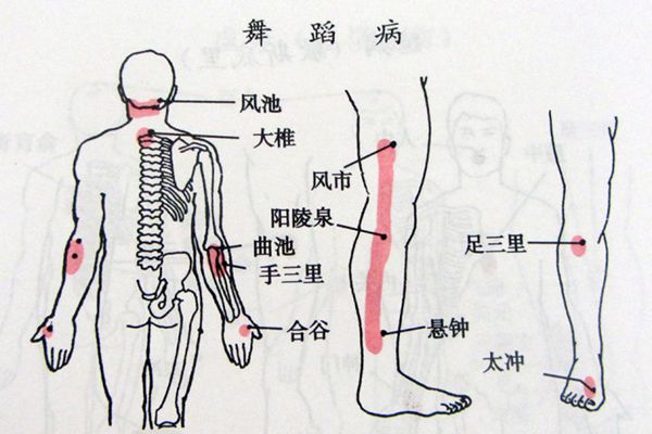 舞蹈病