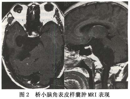 腦內皮樣囊腫