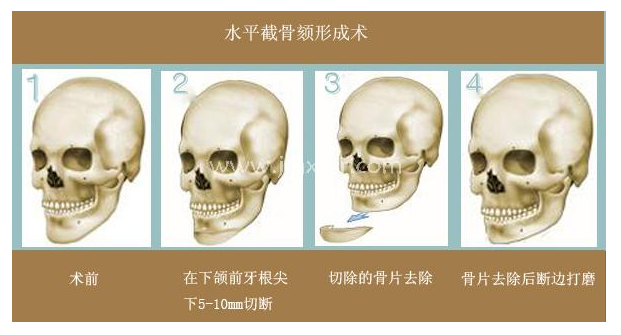 頦成形術