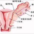 輸卵管粘連