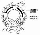 薄腎小球基底膜病