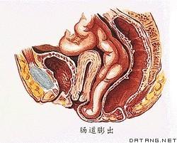 腸膨出