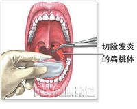 扁桃腺切除手術