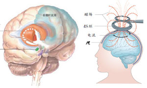 抑鬱症治療儀