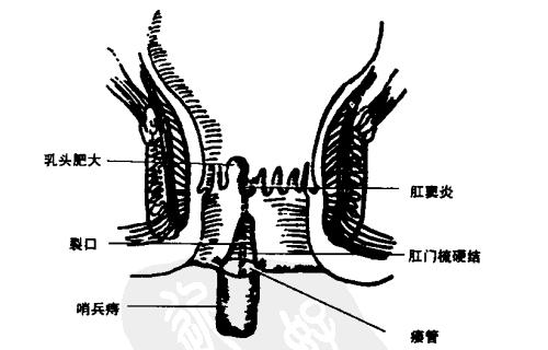 環狀混合痔