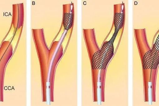 頸動脈血管成形術及支架植入術