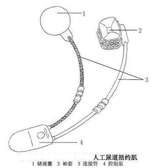 圖1 人工尿道括約肌