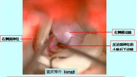 面肌痙攣(臉部痙攣)