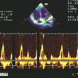 頻譜都卜勒超聲心動圖