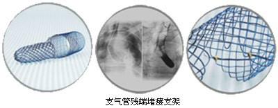 氣管支架