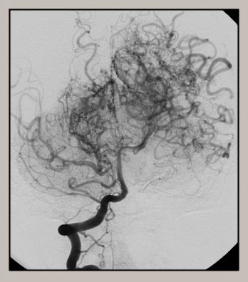 腦底異常血管網症