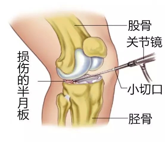 半月板損傷治療