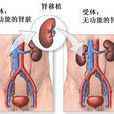 腎移植術後