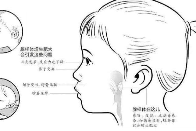 腺樣體切除術