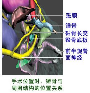 耳硬化的病因