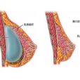 乳房假體