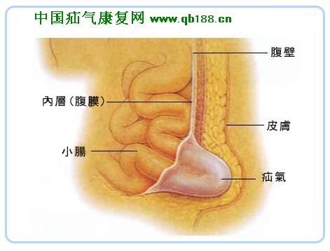 睪丸疝氣