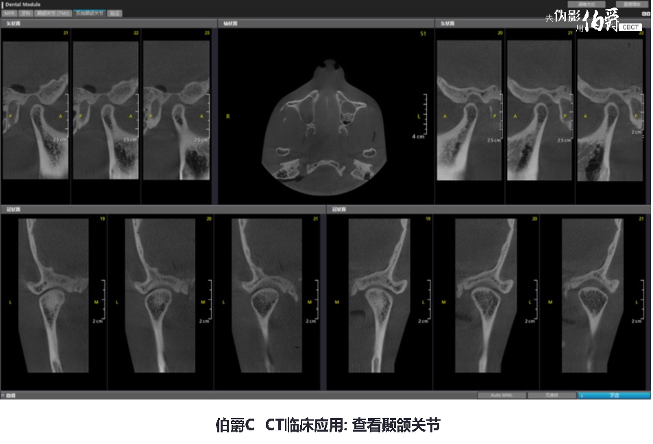 伯爵CBCT