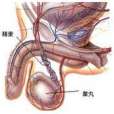 男性生殖腺功能減退症