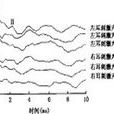 波動性聽力減退