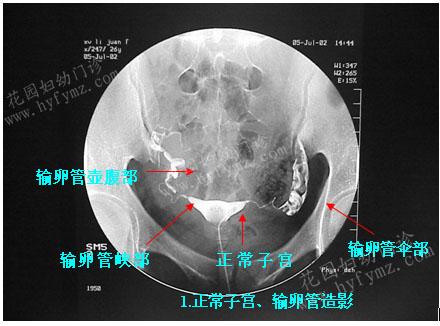 輸卵管積液