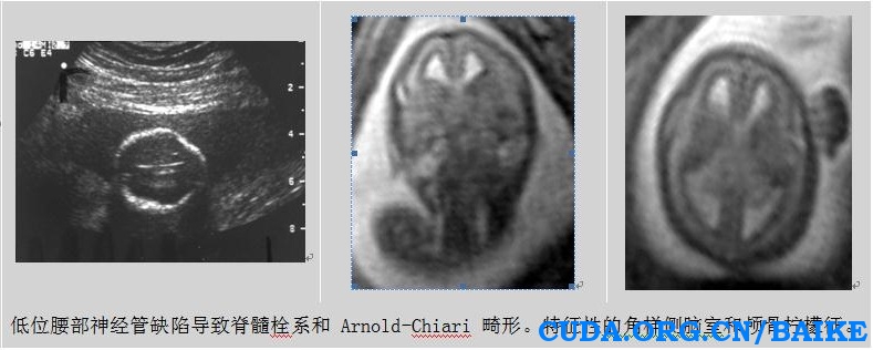 Arnold-Chiria畸形