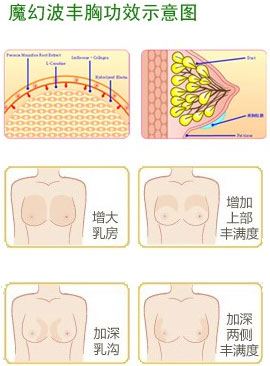 魔幻波豐胸效果示意圖