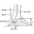 髂內動脈栓塞術