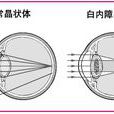 併發症白內障