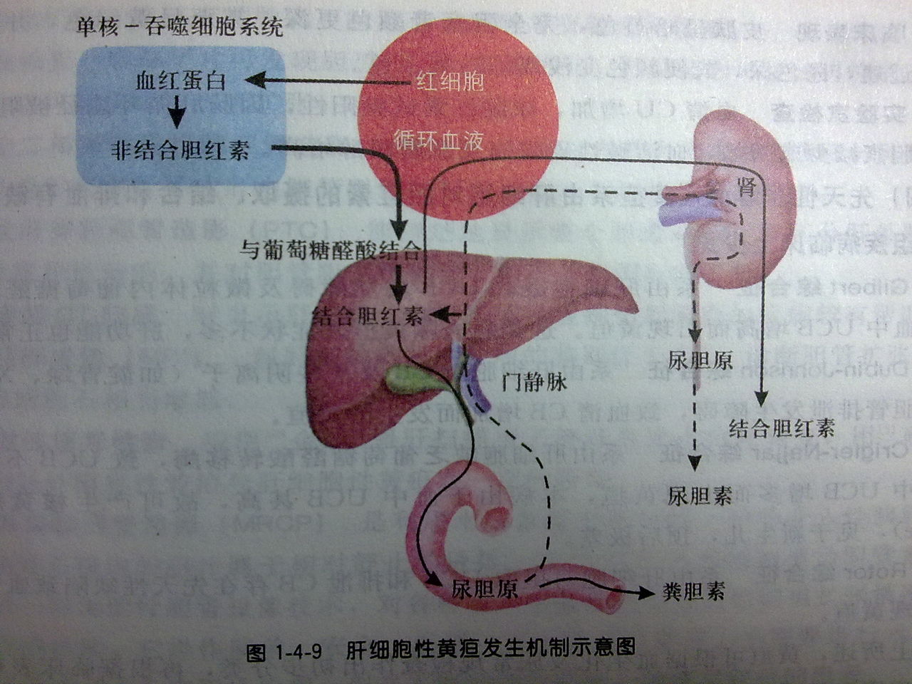 辨析阻塞性黃疸