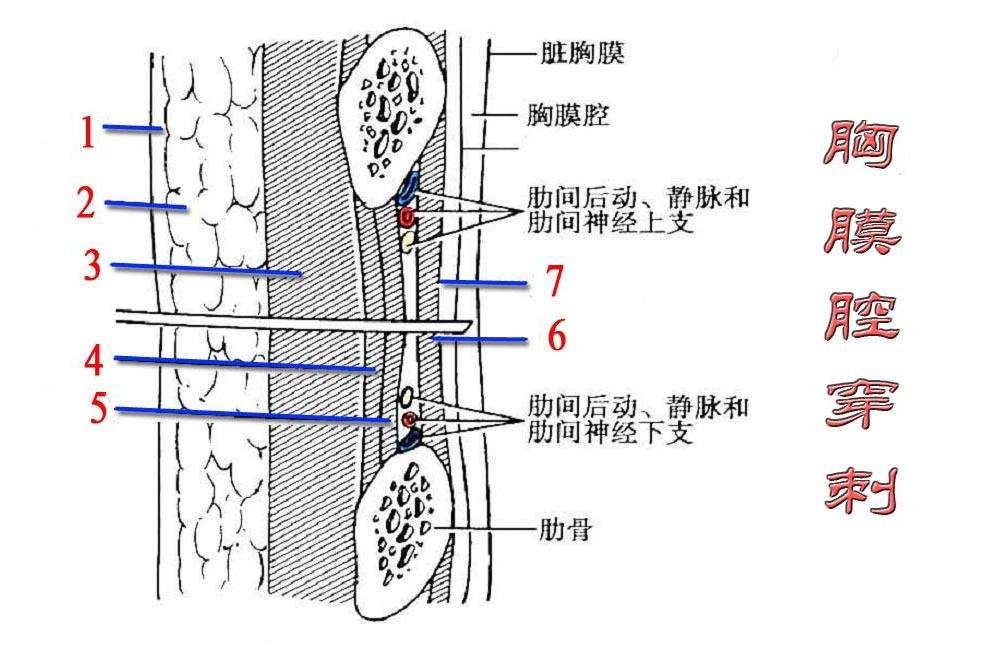 胸膜腔穿刺抽氣法