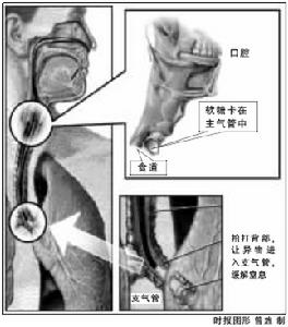 呼吸衰竭