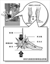 跟腱止點損傷