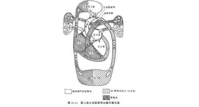 不典型主動脈縮窄症