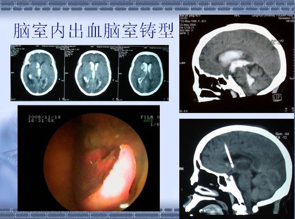 丘腦血腫清除術