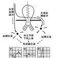 室性融合波